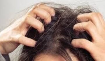 DANDRUFF: FORMS, CAUSES AND TREATMENTS